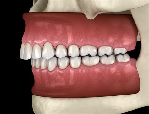 What Is Malocclusion And How Does It Affect Your Oral Health West
