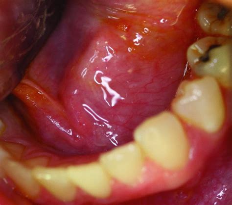 49 Salivary Gland Pathology Pocket Dentistry