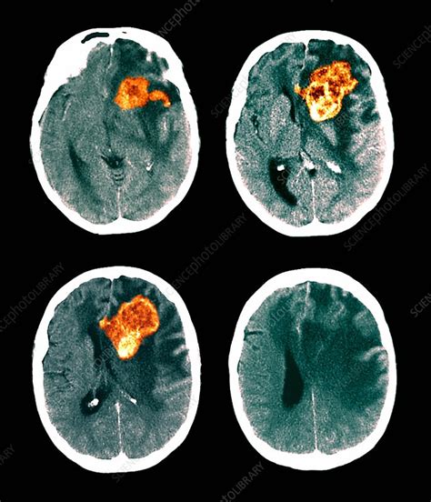 Brain Cancer Ct Scans Stock Image M1340466 Science
