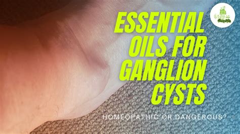 Essential Oils For Ganglion Cysts Homeopathic Or Dangerous Youtube