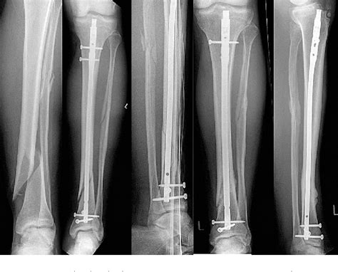 Figure 3 From Tibial Shaft Fractures Management And Treatment Options