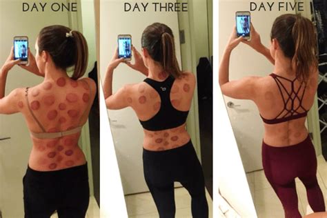 Cupping Therapy Q And A Carly A Hill