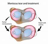 Medial Meniscus Tear Therapy