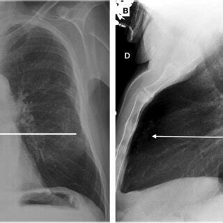 Chest X Ray In Postero Anterior A And Lateral Projection B Shows