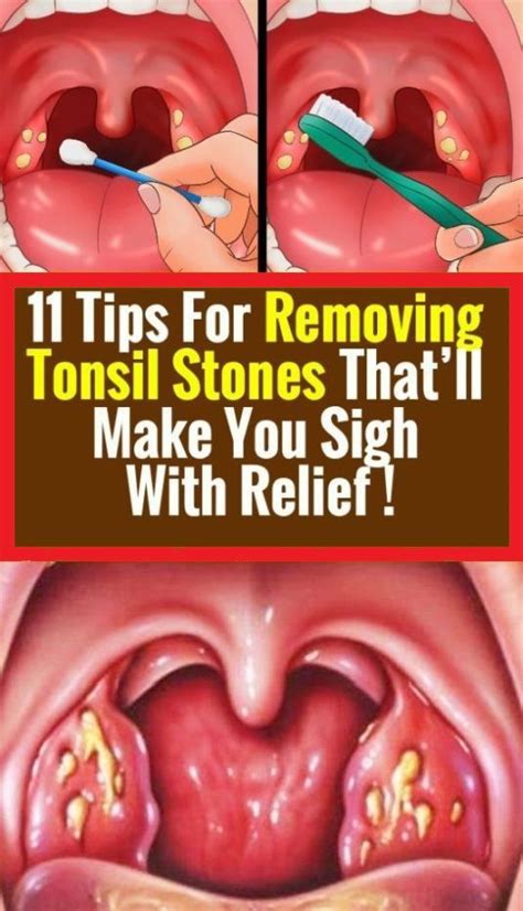 How To Remove Multiple Tonsil Stones Howtoremvo