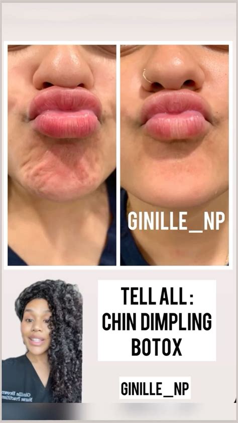 Botox Chin For Chin Dimpling Botox For Wrinkles Smooth Skin With