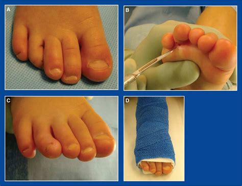Toe Deformities Foot And Ankle Deformities Principles And