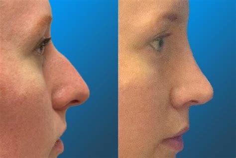 My Rhinoplasty Septoplasty Results After Photo Is 8 Months Post Op