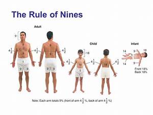 Rule Of Nines Picture Burn Percentage In Adults Rule Of Nines Chart