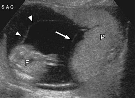 Imaging Of The Placenta A Multimodality Pictorial Review Radiographics