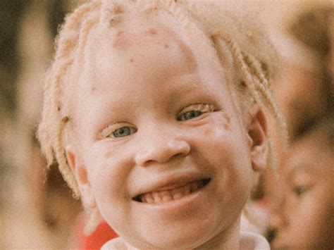 International Albinism Awareness Day 2021 What Is Albinism Causes