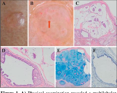 Figure 1 From Primary Mucinous Carcinoma Of The Skin With In Situ