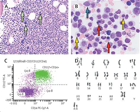 A Complex Karyotype And A Genetic Mutation In Acute Myeloid Leukaemia