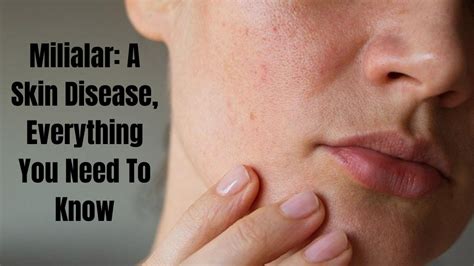 Milialar A Skin Disease Everything You Need To Know