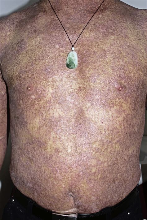 Dermoscopy Of Poikilodermatous Mycosis Fungoides Mf Journal Of The