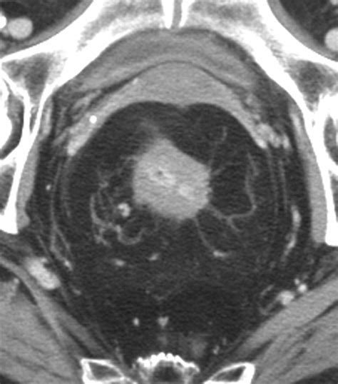 Ct Enterography As A Diagnostic Tool In Evaluating Small Bowel