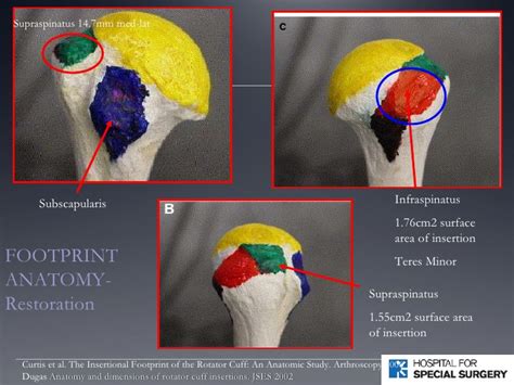 The important bony landmarks in the evaluation of the supraspinatus tendon are the humeral head, the coracoid, the clavicle the anterior limb of the circumflex humeral artery is frequently visible around the tendon. Supraspinatus — Brookbush Institute | Brentbrookbush.com