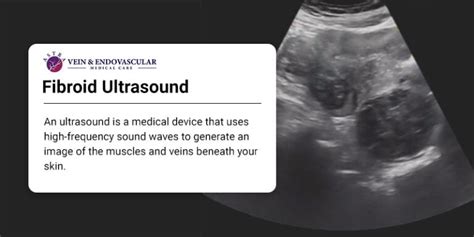 Fibroid Ultrasound Vein And Endovascular Medical Care
