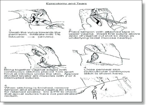 Steps Of Episiotomy Procedure Download Scientific Diagram