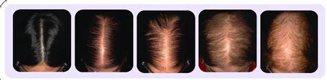 Midscalp Clinical Grading Scale Or Sinclair Scale For Female Pattern Download Scientific