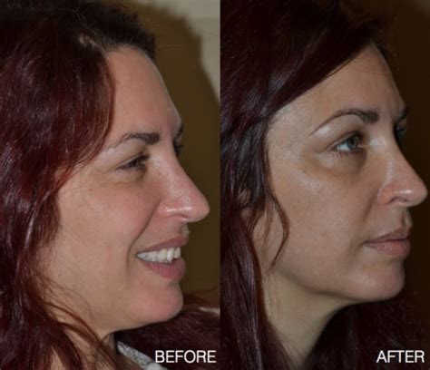 Eyelid Surgery In Rochester New York Envision Eye And Aesthetics