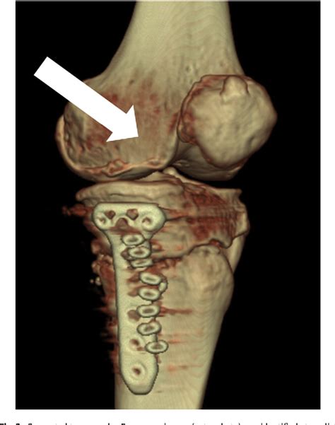 Figure 3 From Impingement Between Medial Plica Against Femoral Condyle