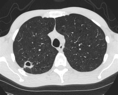 TB Cavitation Lungs
