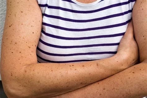 Causes Of Skin Cancer Skin Cancer Risk Factors Readers Digest
