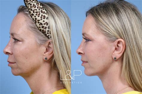 Facelift Before And After Pictures At L P Aesthetics In Palo Alto CA By Drs Lieberman And Parikh