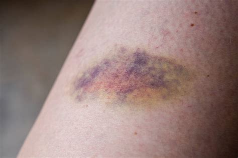 Bruise Stock Photos Pictures And Royalty Free Images Istock