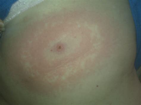 Painful Skin Rash With Blisters Images Roberto Blog