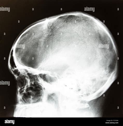 Lateral Skull Hi Res Stock Photography And Images Alamy