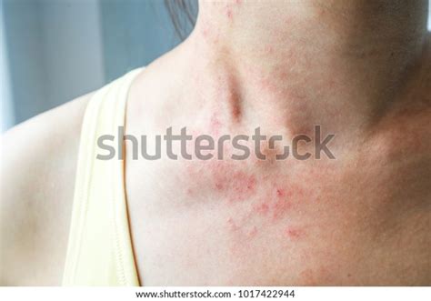 Young Woman Has Skin Rash Itch Stock Photo Edit Now 1017422944