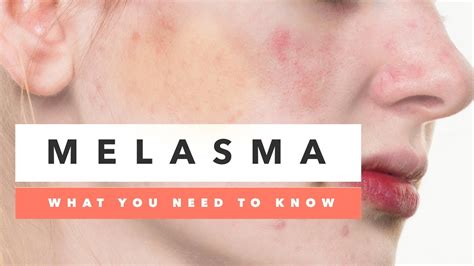 What You Need To Know About Melasma Causes And Treatments Youtube