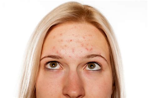 Young Blond With Pimples On Her Forehead Stock Photo Download Image