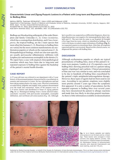 Pdf Characteristic Linear And Zigzag Purpuric Lesions In A Patient
