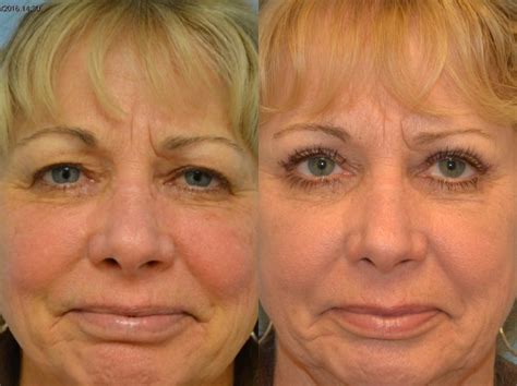 Eyelid Surgery Before And After Photos Patient 163 San Francisco Ca