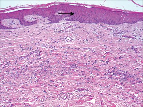 Jle European Journal Of Dermatology Dermpath And Clinic Dermatofibromas