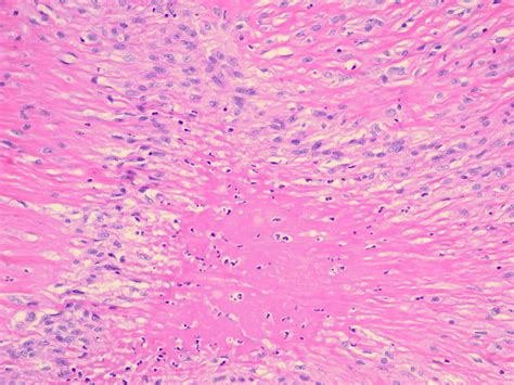 Rheumatoid Nodule Histology