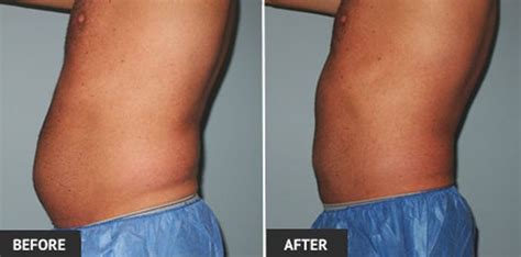 Real Patient Liposuction Before And After Photos By Dr Wright Laser