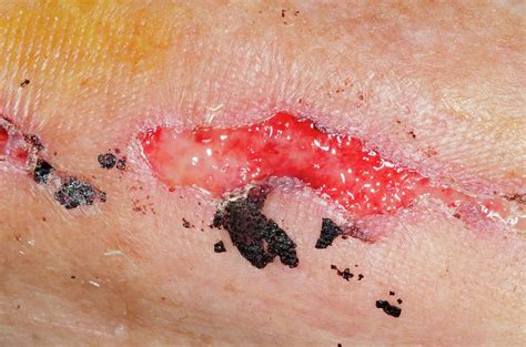 Laceration To The Arm Photograph by Dr P. Marazzi/science Photo Library