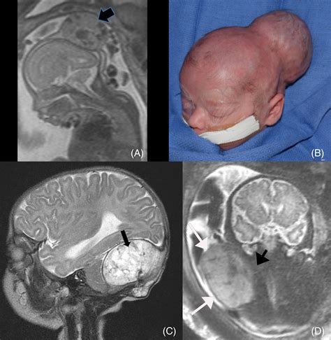 Fetal Brain Head And Neck Tumors Prenatal Imaging And Management