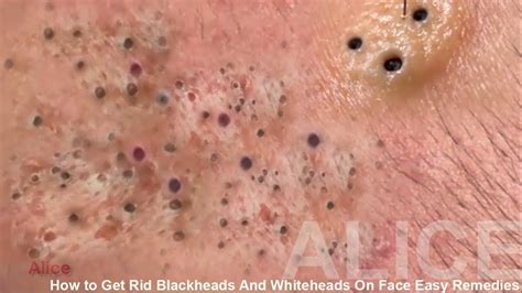 Part 01 How To Removal Blackhead And How To Get Rid Of Blackhead On