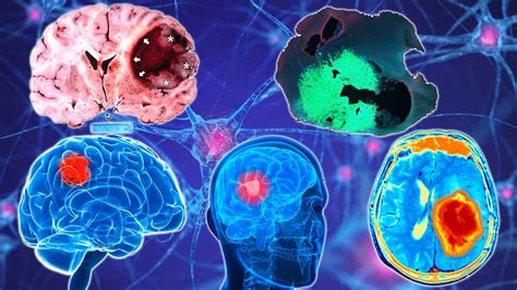 Glioma Brain Tumors Disrupt Neural Synchrony Between Bilateral Cortical