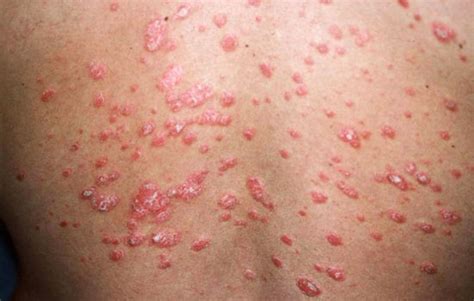 Guttate Psoriasis Dermrounds Dermatology Network