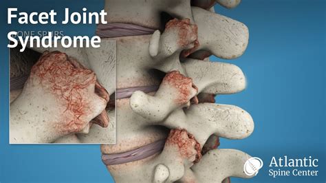 Cervical Facet Joint Syndrome Facet Joint Pain