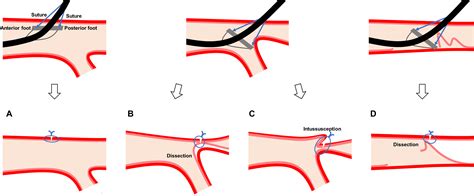 Stenosis Caused By Suture Mediated Vascular Closure Device In An