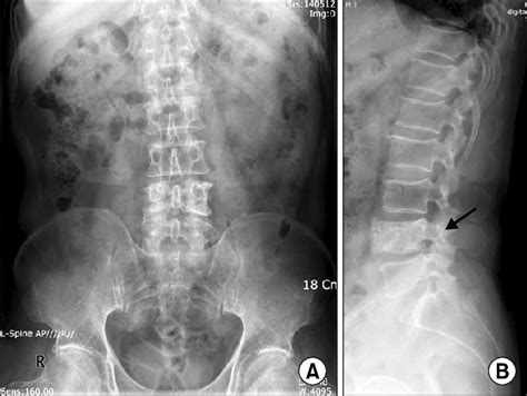 X Ray Showed Only L4 Compression Fracture With Preservation Of The