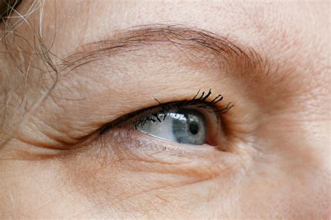 Ptosis Causes And Treatment Fort Lauderdale Eye Institute