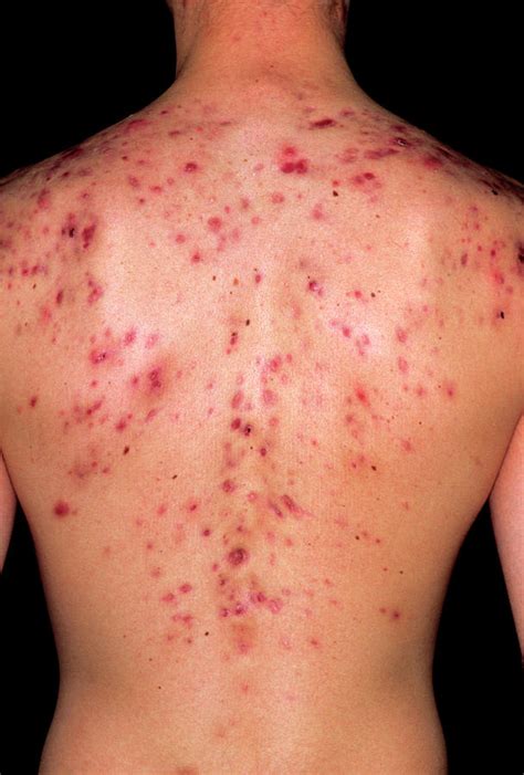 Acne Vulgaris On The Back Of A Young Man Photograph By Dr P Marazzi